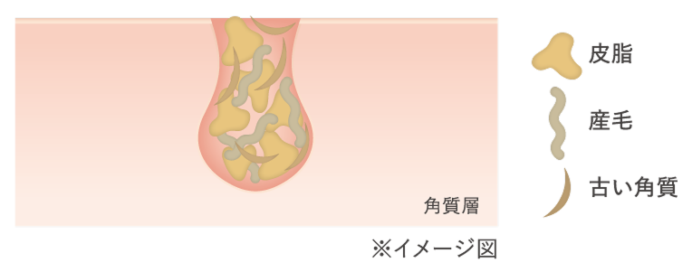 肌に汚れが溜まった状態
