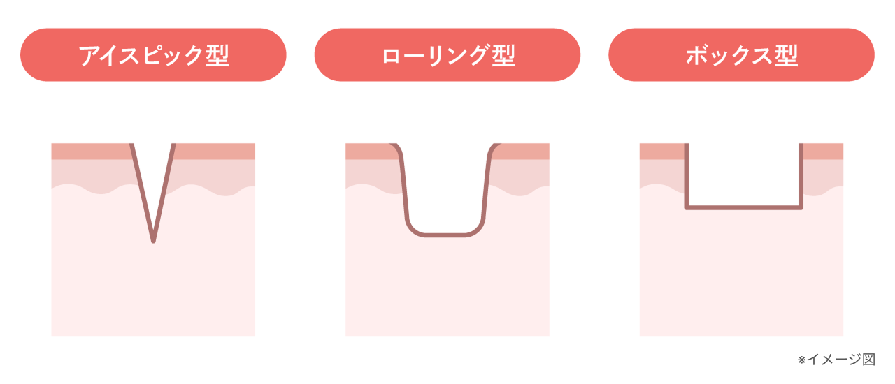 クレーター状のニキビ型3種