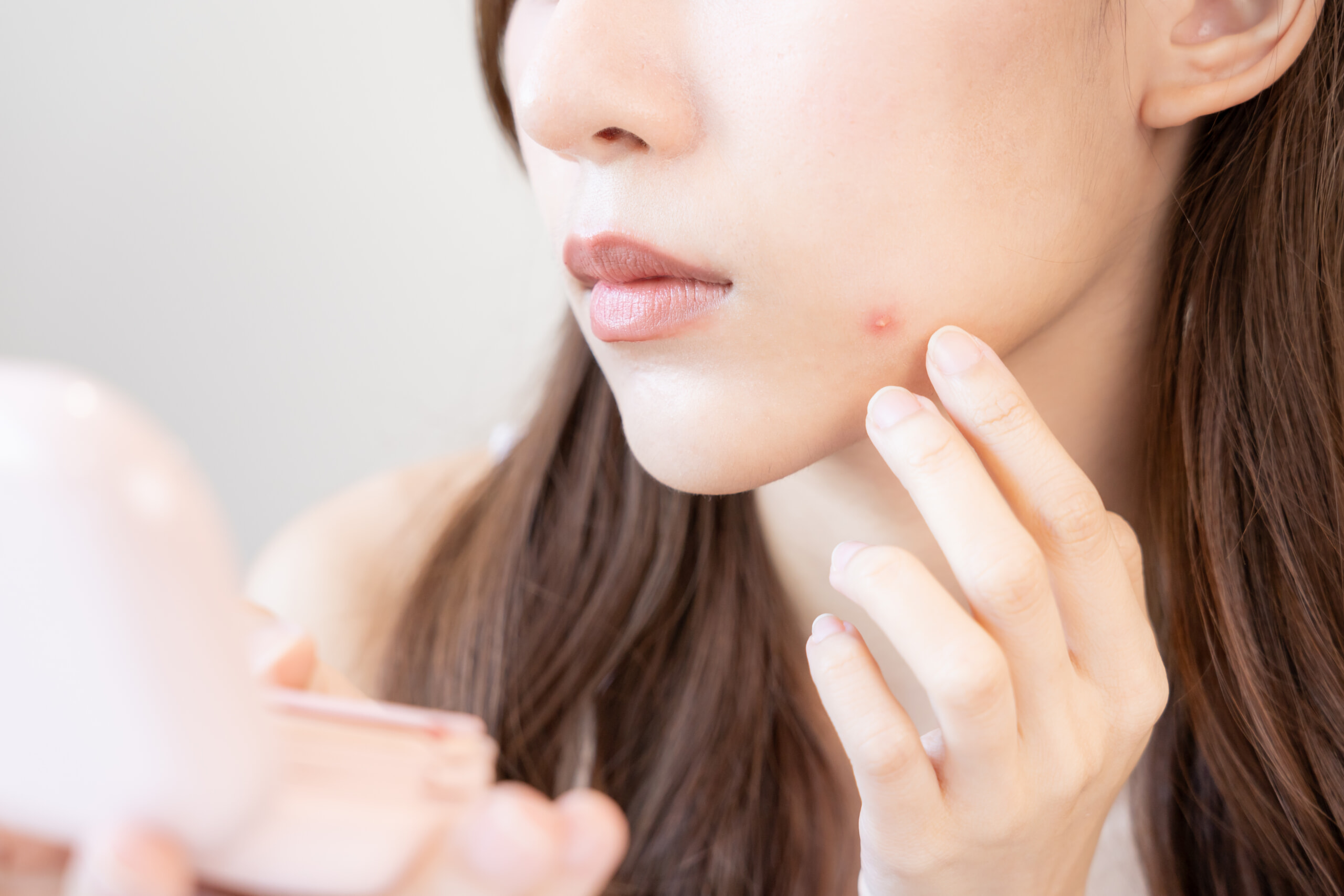 吹き出物(ニキビ)を気にする女性