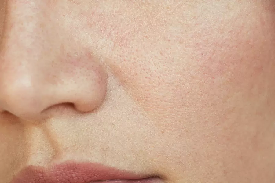 Nguyên nhân nào khiến da mất độ ẩm?