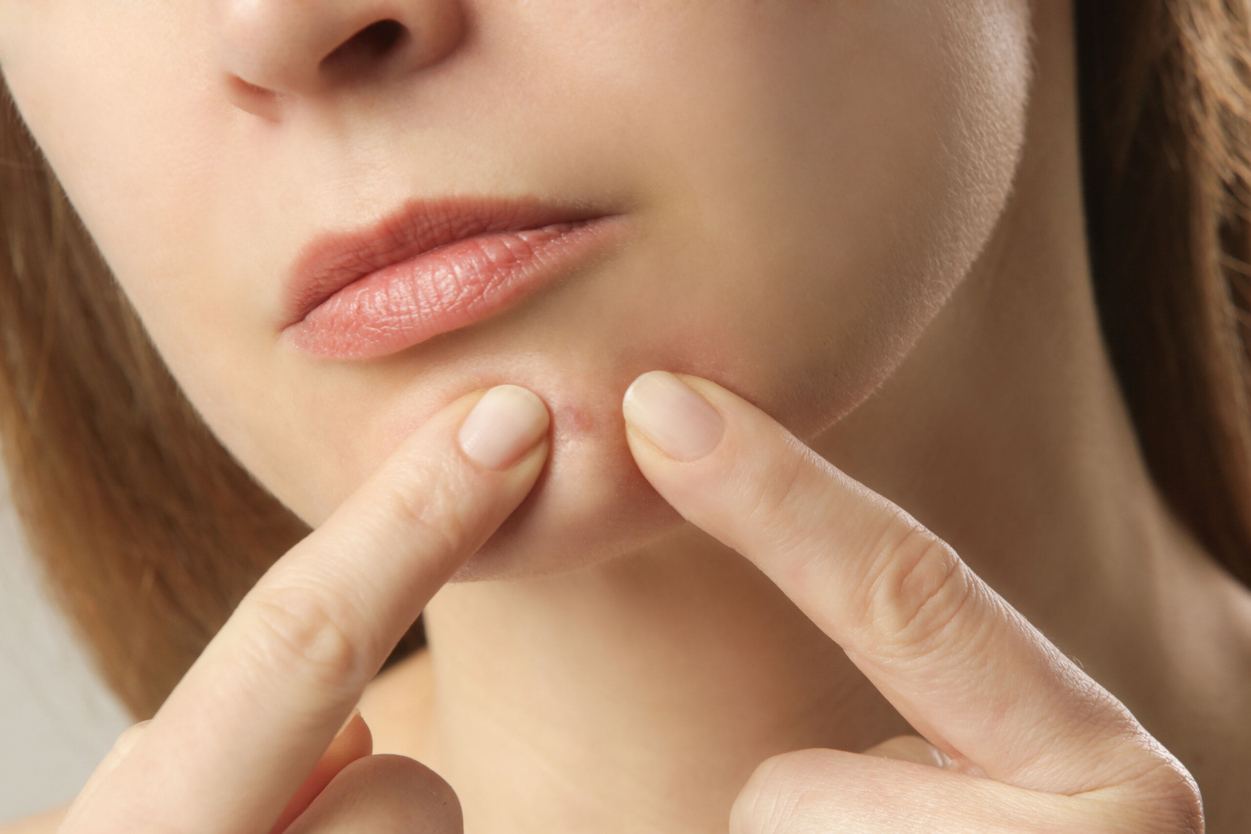 吹き出物(ニキビ)を気にする女性