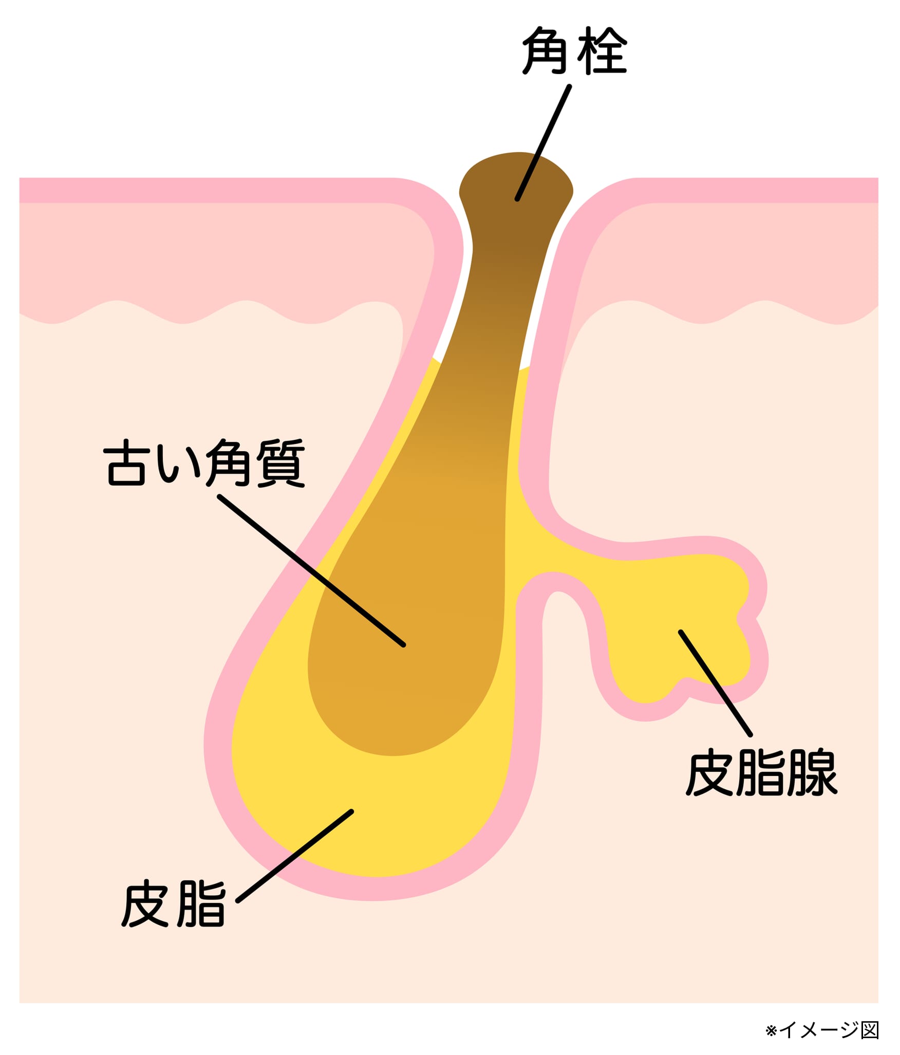 図解_角栓のある毛穴