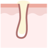 イラスト_詰まり毛穴