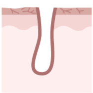 イラスト_乾燥毛穴