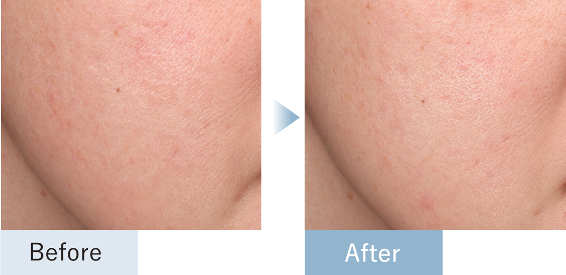 くすみ・色むらがある肌のアップ　透明感のある肌のアップ