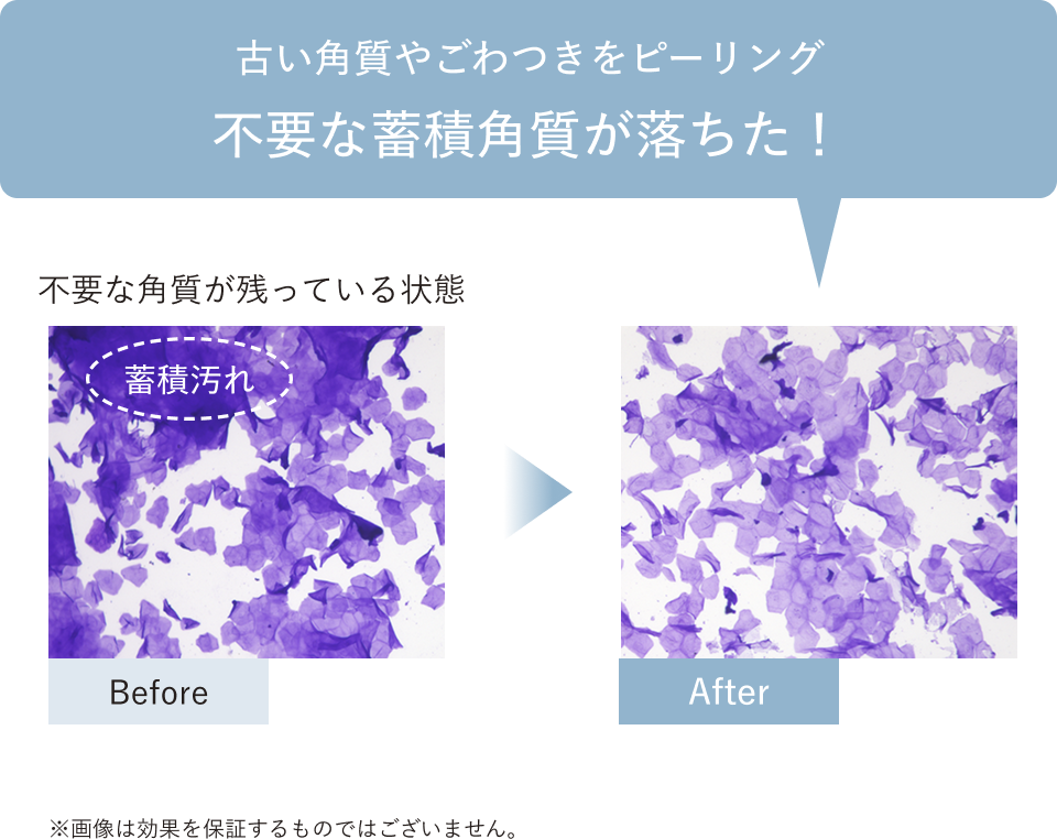 不要な角質が残っている状態、古い角質やごわつきをピーリング 不要な蓄積角質が落ちた