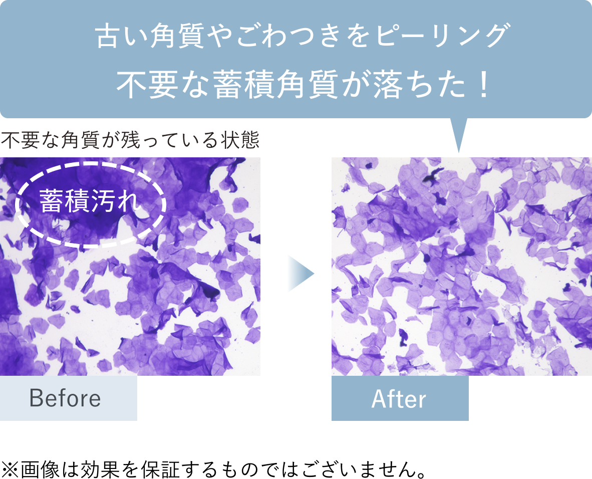 不要な角質が残っている状態、古い角質やごわつきをピーリング 不要な蓄積角質が落ちた